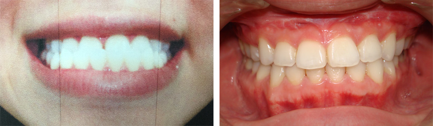 Orthodontic Treatment Photo #4